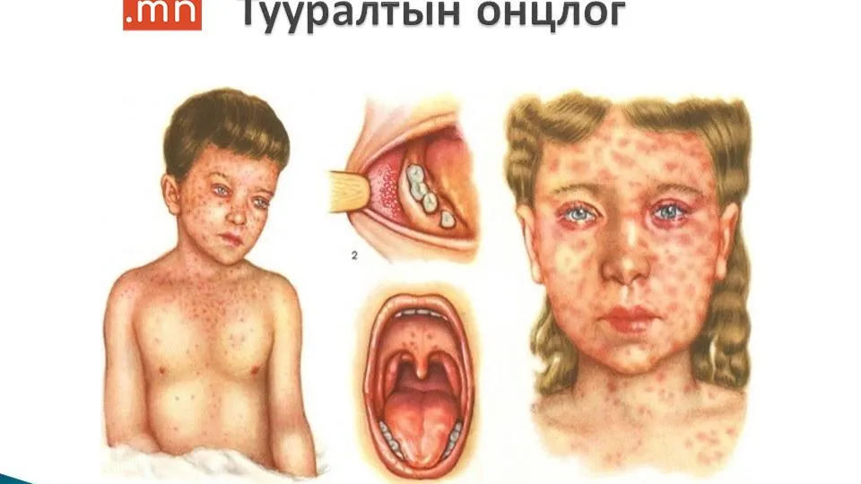 УЛААНБУРХАН ӨВЧНИЙ ДЭГДЭЛТИЙН ХАРИУ АРГА ХЭМЖЭЭ АВЧ АЖИЛЛАХЫГ ҮҮРЭГ БОЛГОЛОО