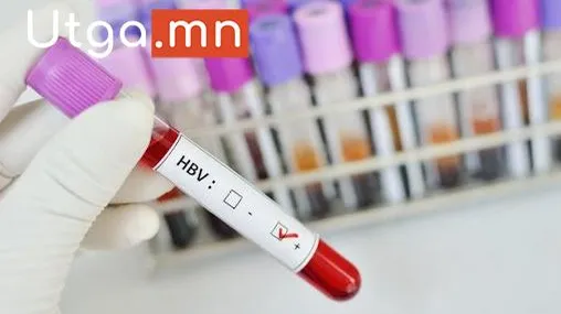 ГЕПАТИТЫН D ВИРУСИЙН ХАЛДВАРТАЙ 66 МЯНГАН ХҮН БАЙНА